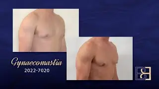 Moderate Gynaecomastia [BB grade 2a] {Patient 2022-7020} Before & After 12 Months Post Surgery
