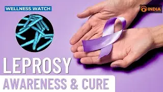 Leprosy: Awareness & Cure | Wellness Watch