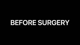 Look at This Patient's Beautiful Breast Augmentation Results Shown 3 Months Post-Op