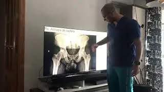 Rx. Artrosis de cadera