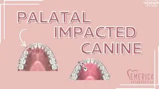 How Do Braces Help A Palatal Impacted Canine?