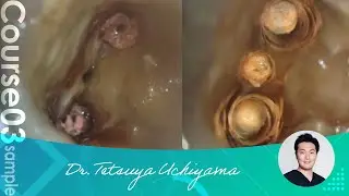 【Microscope magnification in General Dentistry】Advantages & Techniques by Dr. Tetsuya Uchiyama