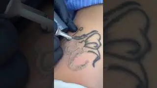 Удаление любых цветных, ярких, насыщенных татуировок 🎨 Пикосекундный лазер PicoSure