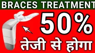 Braces Treatment 50% तक तेज़ करें | ACCELEDENT | Braces Treatment fastening Dental Device |