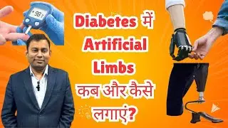Artificial Limbs For Diabetes Patient | Bornlife Artificial Limbs Centre #artificialleg #prosthesis