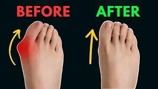 BUNION: How to fix it at home WITHOUT surgery