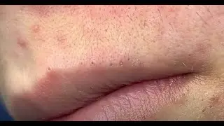 Blackhead Removal: Satisfying  Routine | 110