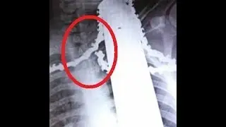 Tree Trimmer Survives Having Chainsaw Lodged In His Neck