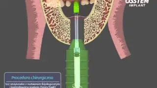Sinus lift metodą zamkniętą za pomocą zestawu CAS KIT Osstem Animacja PL