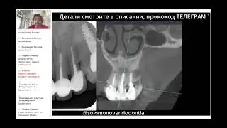 Важные нюансы оценки КЛКТ в эндодонтии | Доктор Соломонов
