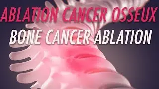 Ablation de metastases osseuses -  Interventional Therapy for metastatic bone disease