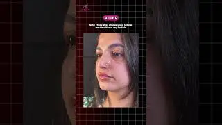 Dr. Simrat Sandhu | Lip Fillers: Before-After