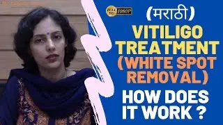 Vitiligo Treatment | White Patch on Face and Skin Treatment (in MARATHI) by Dr Rinky Kapoor, Mumbai