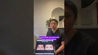 Dr. Lao explains briefly what Asian double eyelid surgery is and why it&rsquo;s so popular in Asia.