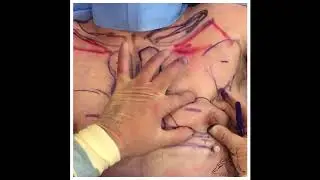 CHEST OPTIMIZATION HIGH DEFINITION LIPOSUCTION AND CHEST SHAVING WITH FAT GRAFTING