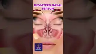 The Nasal Septum: Why It Matters for Your Breathing