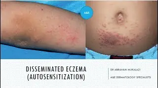 DISSEMINATED ECZEMA (ID REACTION ) EXPLAINED BY DR ABRAHAM #dermatology #lecture #educational