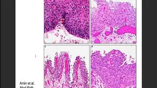 Updates in Urologic Pathology WHO Made Those Changes?!