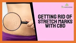 Is CBD good in stretch marks? - Useful CBD skin care benefits!