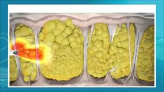Cellulite Reduction in New Jersey