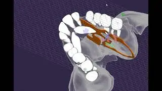 Localization of impacted canines for orthodontic traction