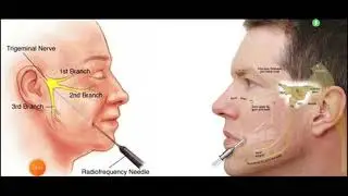 Functional neurosurgery 1