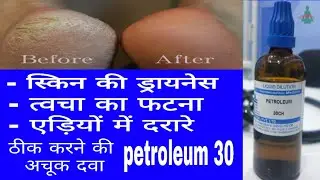 petroleum 30 | best medicine for cracked heels | best medicine for winter problem | cracked skin