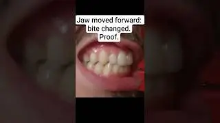 #Jaw moved forward. Proof: bite changed.