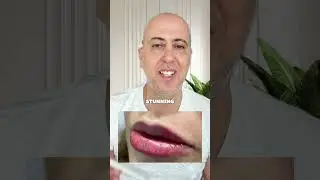 Lip Filler in Beverly Hills Wellness Center & Med Spa, Palm Beach, Florida @Shorts #shorts medical