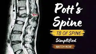 Pott's Spine l TB of Spine l Pott's Paraplegia l Pathogenesis l Symptoms l Diagnosis l Management l