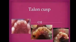 what is Talon cusp?(mfds,mjdf,Bds)