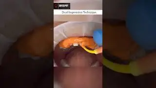 Dual Impression Technique for Zirconium Bridge #shorts #dentist #impression #prosthodontics