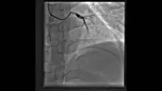 Multivessel disease in setting of STEMI.