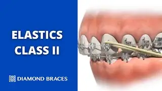 Elastics Class II: Visual Guide to Function and Results