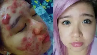 My Acne Story   1 Year Post Treatment Skin Update