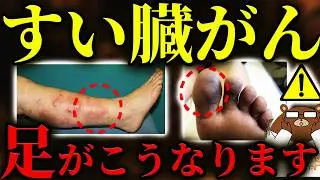 【超意外な初期症状】放置厳禁！知らないと後悔するすい臓がんの「足」の危険サイン。黒ずみ.腫れ.湿疹..意外な兆候とは？「沈黙の臓器」すい臓がんに予防法はあるのか？医師が徹底解説。