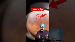 Laser for Saving Vision !
