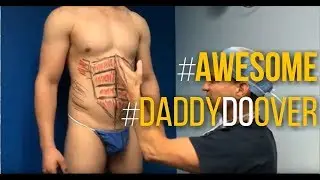 Daddy Do Over Surgery Which Includes Male Calf Implants, Gluteal Augmentation and Liposuction