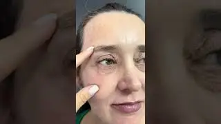 Antes e Depois procedimento est&eacute;tico facial #pele #beleza #saude #detox #botox #dicasdebeleza #rugas