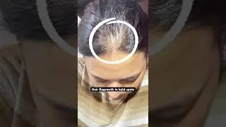 Rosemary oil for Hairfall & hair Regrowth