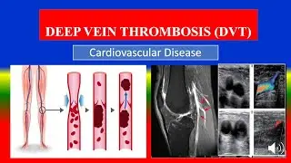 DEEP VEIN THROMBOSIS (DVT) - Definition, types, causes, patho, symptoms, diagnoses, medicine