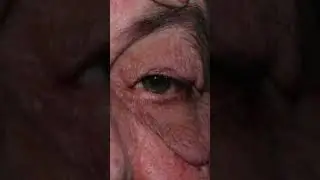 AMAZING Lower Eyelid Lift Results You Won't Believe!