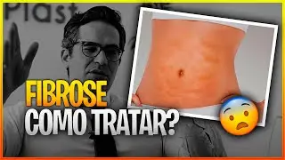 COMO TRATAR A FIBROSE APÓS LIPOASPIRAÇÃO? 😨
