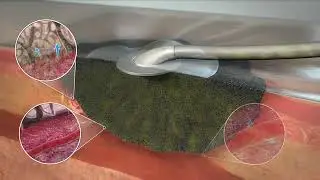 M&aacute;y điều trị vết thương Acelity   ACTIV A C &trade; Negative Pressure Wound Therapy System