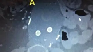 Infected cystic Hygroma following AAA repair Lee Kirksey MD Cleveland Clinic