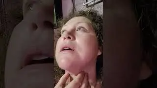 Day 33 Mini facelift Recovery Journey