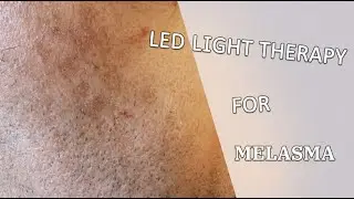 Is LED Light Therapy Worth It For Melasma?