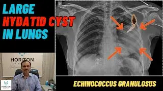 Large Hydatid Cyst in Lungs | Echinococcus Granulosus | Dr. AK Dwivedi