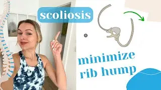 How to minimize the rib hump? | SCOLIOSIS