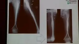 Flexible intramedullary nails in femur